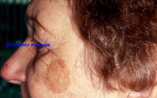 Seborrhoeic Keratosis5